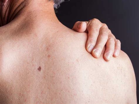 On the other hand, the. HIV Rash: What Does It Look Like and How Is It Treated?
