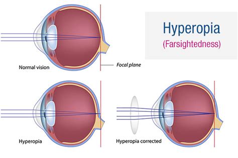 Hyperopia And Hypermetropia Best Eye Care Centre