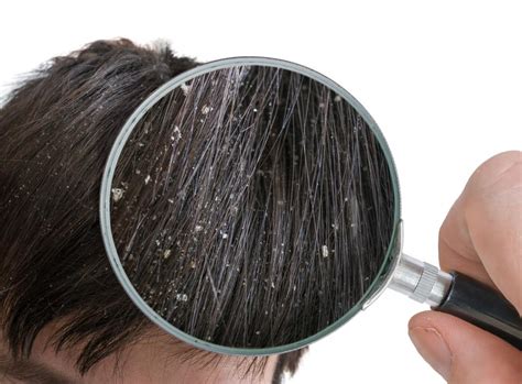 Dandruff: Causes and treatments