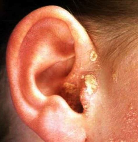 Dry Skin In Ears Treatment