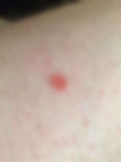 Can Anybody Tell Me What This Rash Is Its A Small Red Circle That Has