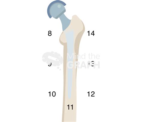 Gruen Zones Lateral Bone Full