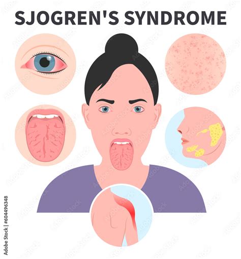 Sjogrens Syndrome Dry Eye Lymph Nodes Redness Saliva Sialadenitis