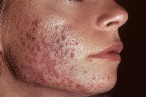 Hormonal Antiandrogen Therapy For Acne May Help Reduce Antibiotic Use Endocrinology Advisor
