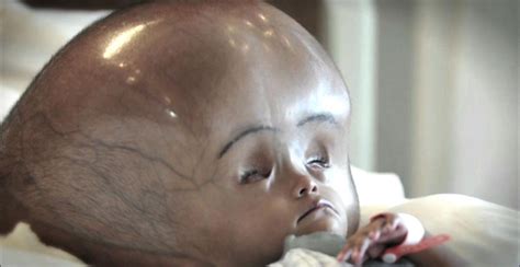 Learn Something Interesting The Effects Of Hydrocephalus