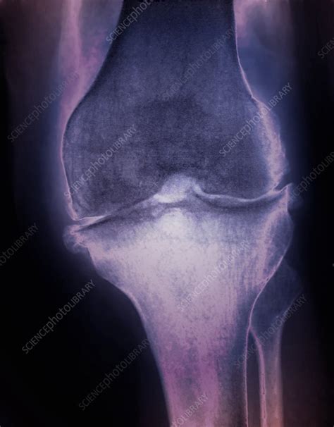 Osteoarthritis Of The Knee X Ray Stock Image C0468595 Science