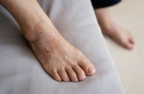 Why Do I Have Psoriasis On My Feet Hanna Sillitoe