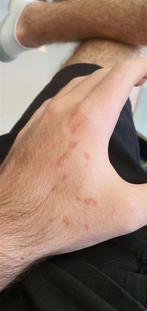 Strange Marks Appeared 2 Weeks Ago And Arent Going Away I Did Not