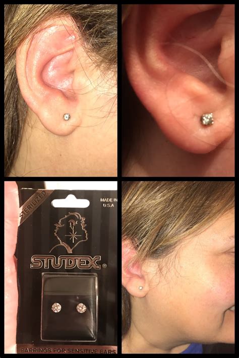 Contact Dermatitis Ear Piercing Ph