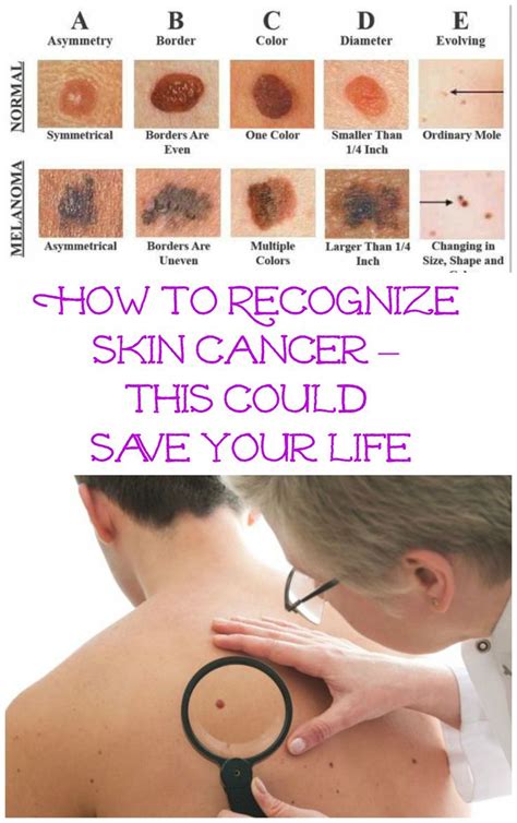 This acronym is used for early warni. 17 Best images about Squamous cell carcinoma on Pinterest ...