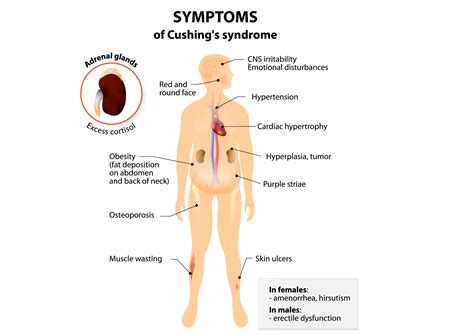 Plantations vs natural forests 2.2. Cushing's Disease vs. Cushing's Syndrome—The Cortisol ...