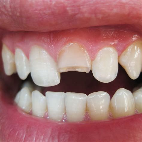Chipped Tooth Repair The Applecross Dentist