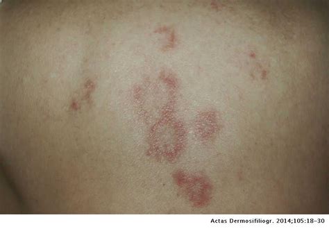 Drug Induced Lupus Erythematosus Actas Dermo Sifiliográficas