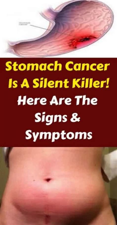 Stomach cancer may cause any of the following signs and symptoms. Stomach Cancer: A Silent Killer- Most Common Symptoms (Don ...