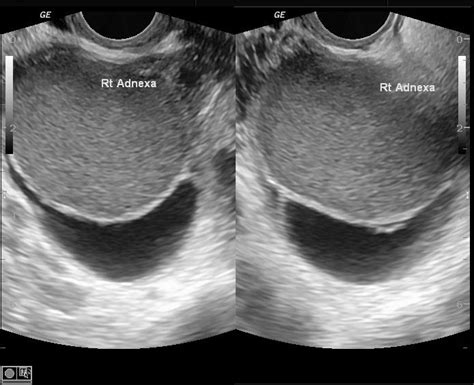 Endometrioma Radiology Reference Article Radiopaedia Org Medical