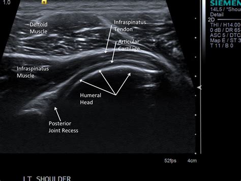 Anterior graphic of the shoulder. Shoulder Therapeutic Injection