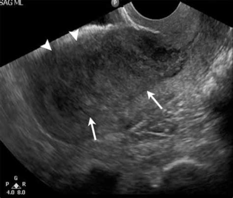 A 72 Year Old Female With Endometrial Cancer Longitudi Open I