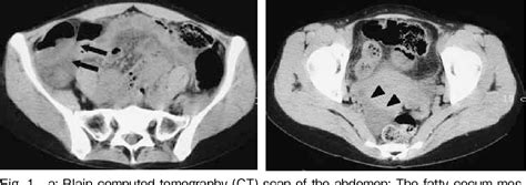 Figure 1 From A Case Of Perforated Appendicitis Caused By A Small