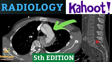 Radiology Quiz Kahoot 5th Edition Gamification Youtube