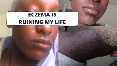 Weeping Eczema And Is This Contact Dermatitis Cleared In 8 Days