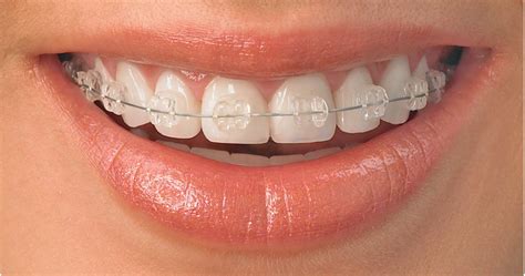 Clear Braces Vs Metal Braces Which One Is Right For You Demotix
