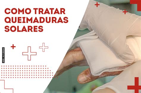 Como tratar queimaduras solares Paraná Clínicas