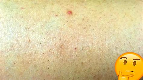 What To Do About Ingrown Hair On Legs The Practical Beauty 4 The