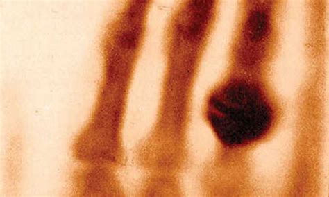 Worlds First Human X Ray 1895 Röntgens Wife Hand Bioengineerorg