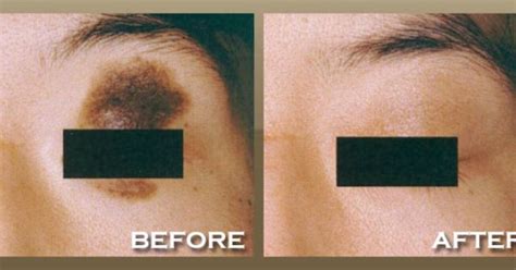 How To Get Rid Of Birthmark On Face Naturally At Home Fast And Can You