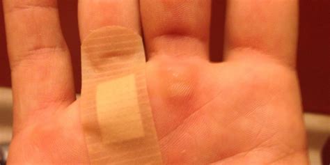 How To Heal Ripped Callous Hands Bc Guides