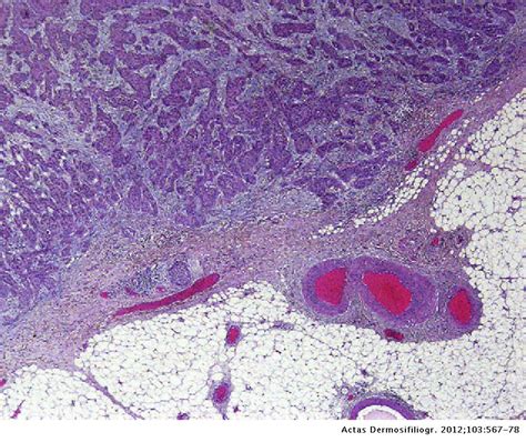 High Risk Cutaneous Squamous Cell Carcinoma Actas Dermo Sifiliográficas
