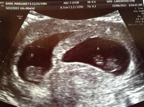 Twin Parenting Twin Ultrasound 8 Weeks