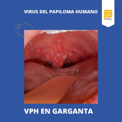 Papiloma Y Cancer De Garganta Hpv Skin Rash On Arms And Torso My XXX Hot Girl