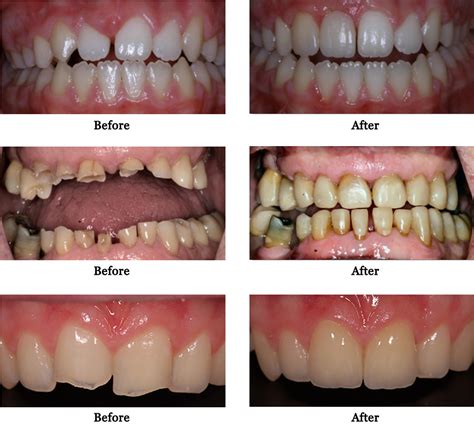Composite Restorations Tauranga Dental Specialists