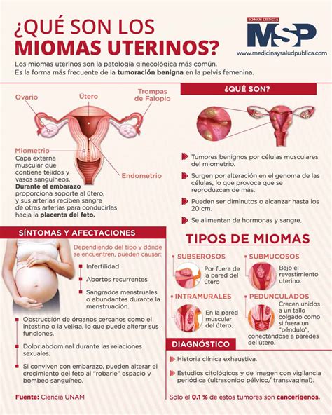 Qu Son Los Miomas Uterinos Infograf A