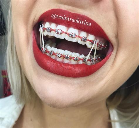 The Best Best Color For Braces That Isn T Noticeable References