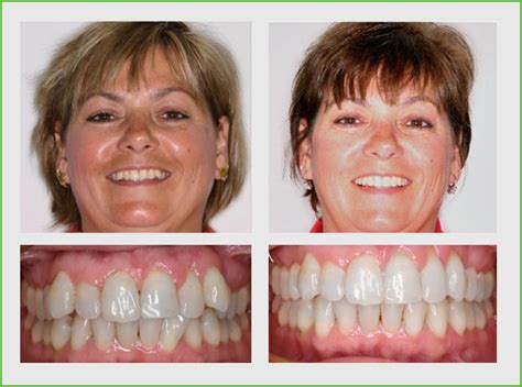 Invisalign Before And After Orlando Fl