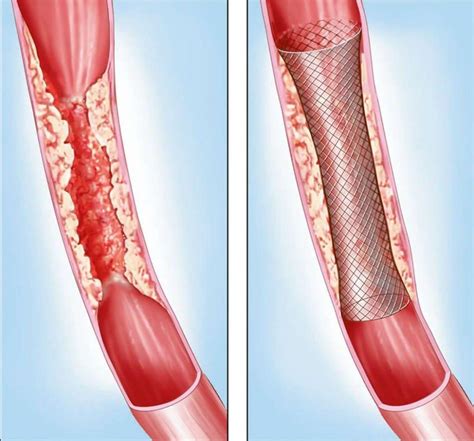 Stenting Bel Air Md And Towson Md Vascular Surgery Associates Llc