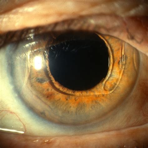 Anterior Chamber Intraocular Lens Retina Image Bank