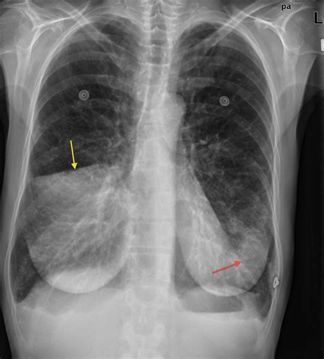Right Middle Lobe Lung Captions Week