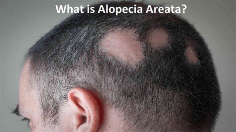 What Is Alopecia Areata Its Causes Symptoms Treatment Diagnosis