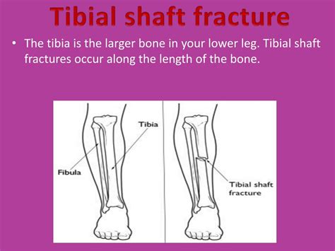 Ppt Case Presentation On Tibial Fracture Powerpoint Presentation