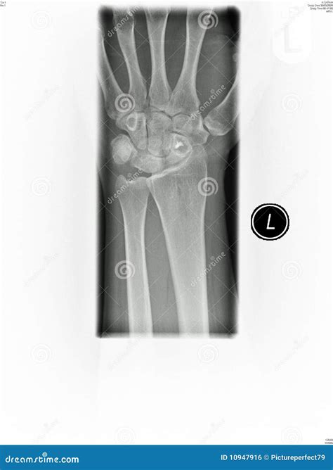 Wrist X Ray Stock Photo Image Of Accident Xrays Operation 10947916