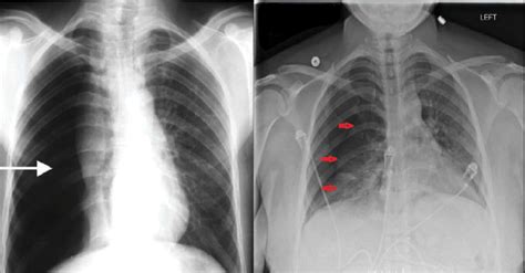 A Chest X Ray Showing Right Sided Pneumothorax Collap