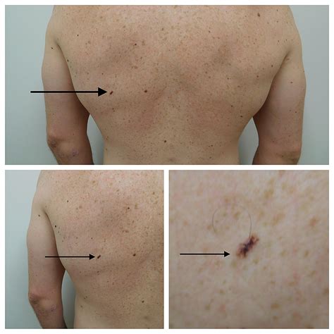 Cureus Linear Malignant Melanoma In Situ Reports And Review Of Cutaneous Malignancies