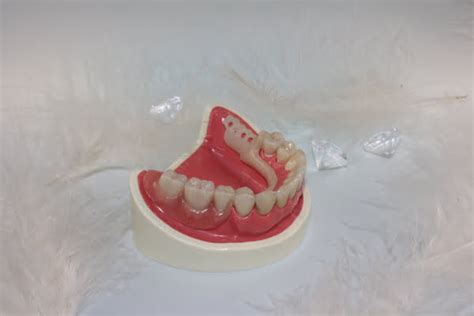 Relieve Irritation From Dentures Denture Clinic Mississauga