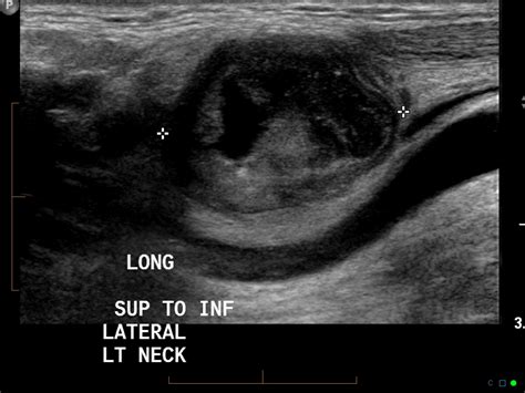 Metastatic Squamous Cell Carcinoma Neck Lymph Node Image
