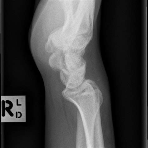 Normal Scaphoid Series 2 موقع الأشعة التعليمي