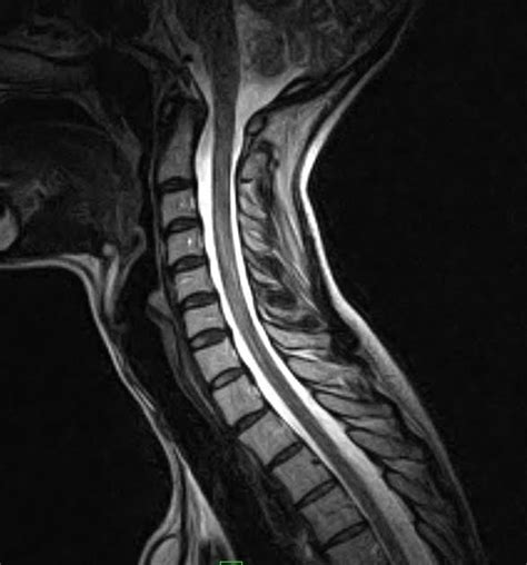 Flexion And Extension Cervical Mri Sumers Radiology Blog