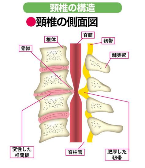 狭窄症で首が痛い!? 若者にも多い「首の脊柱管狭窄症」とは ...